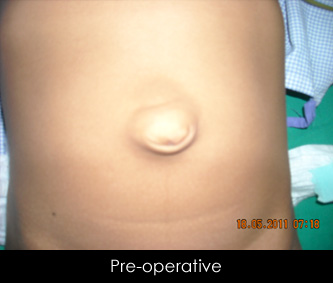 Umbilical hernia repair (child)