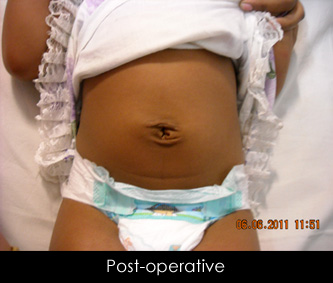 Dr. Subhasis Saha - Expert in Pediatric Plastic Surgery - India